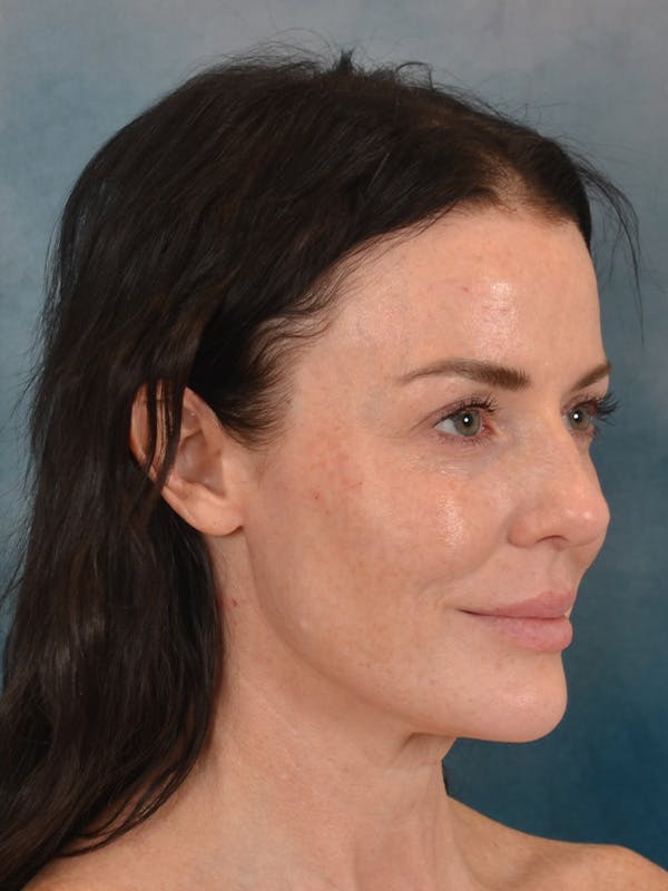 Deep Plane Facelift Before & After Gallery - Patient 275248 - Image 7
