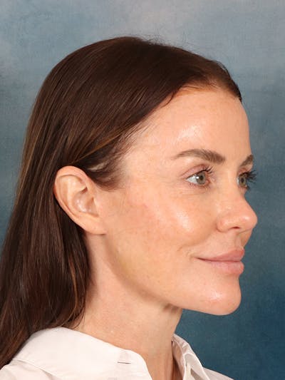 Deep Plane Facelift Before & After Gallery - Patient 275248 - Image 8