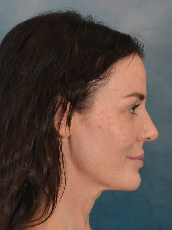 Deep Plane Facelift Before & After Gallery - Patient 275248 - Image 9