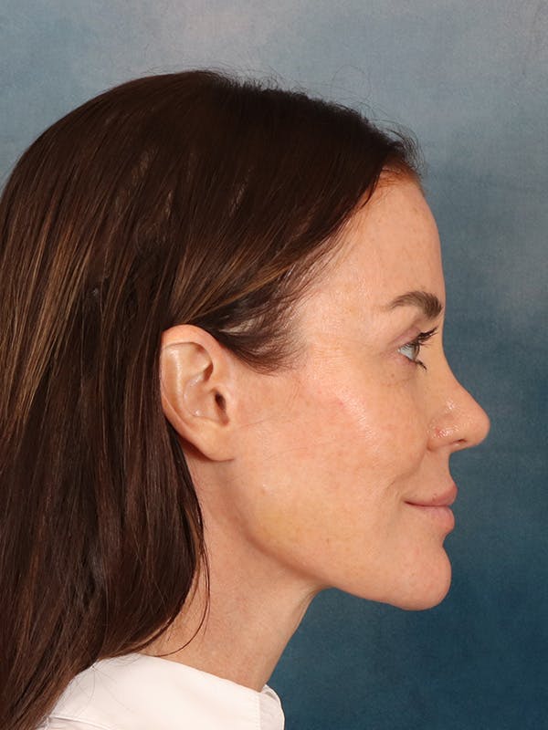 Deep Plane Facelift Before & After Gallery - Patient 275248 - Image 10