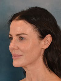 Deep Plane Facelift Before & After Gallery - Patient 275248 - Image 1