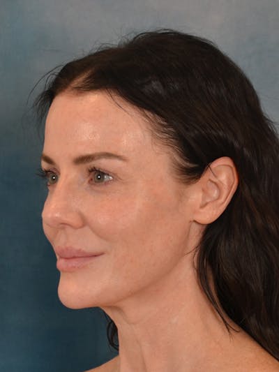 Deep Plane Facelift Before & After Gallery - Patient 275248 - Image 1