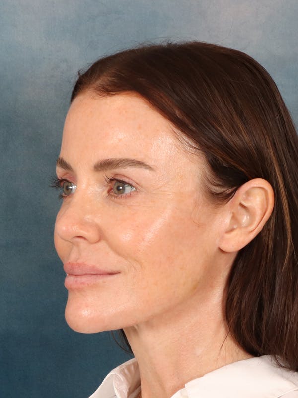 Deep Plane Facelift Before & After Gallery - Patient 275248 - Image 2
