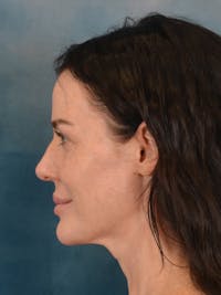 Rhinoplasty Before & After Gallery - Patient 838181 - Image 1