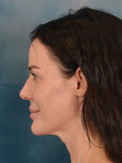 Rhinoplasty Before & After Gallery - Patient 838181 - Image 1