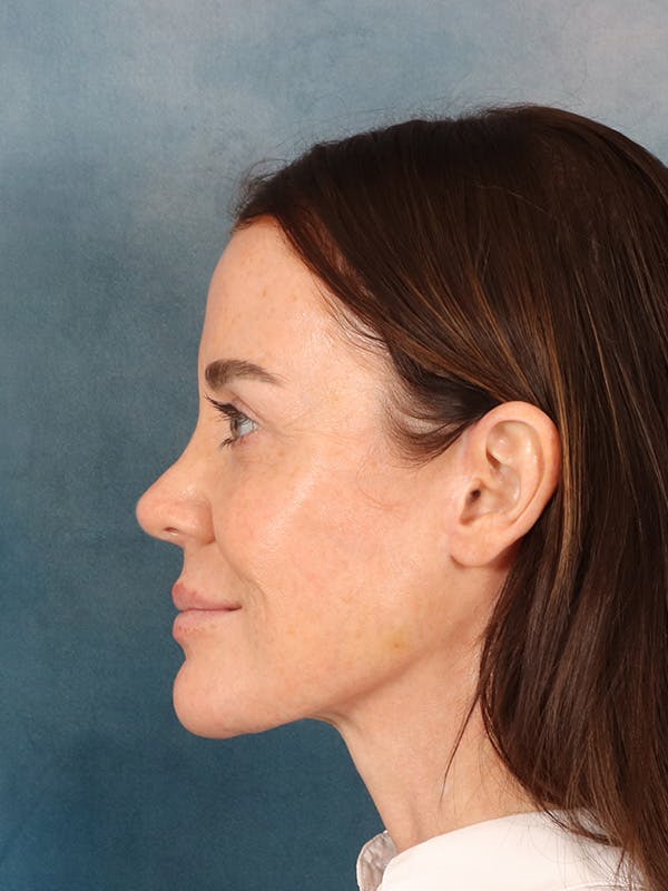 Deep Plane Facelift Before & After Gallery - Patient 275248 - Image 6