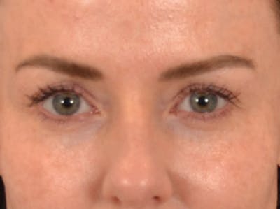 Eyelid Lift Before & After Gallery - Patient 173585 - Image 1
