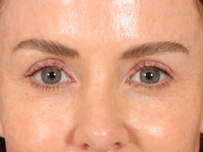 Eyelid Lift Before & After Gallery - Patient 173585 - Image 2