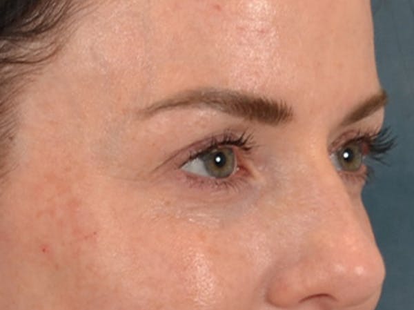 Eyelid Lift Before & After Gallery - Patient 173585 - Image 3
