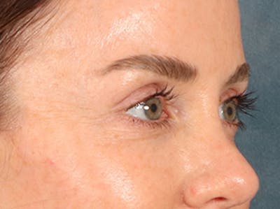 Eyelid Lift Before & After Gallery - Patient 173585 - Image 4