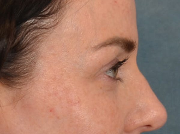 Eyelid Lift Before & After Gallery - Patient 173585 - Image 5