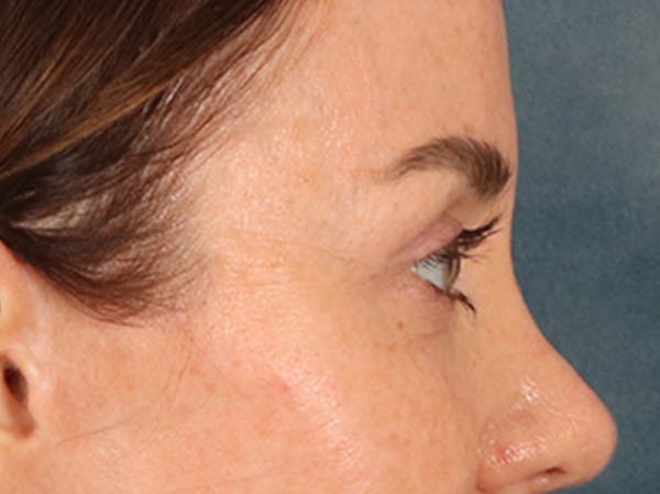 Eyelid Lift Before & After Gallery - Patient 173585 - Image 6