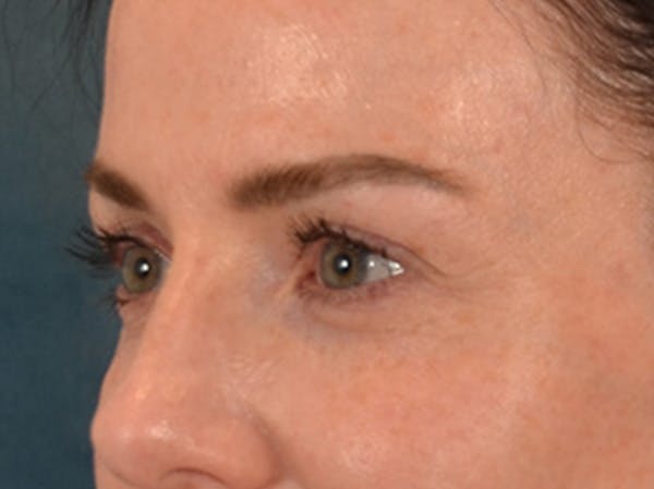 Eyelid Lift Before & After Gallery - Patient 173585 - Image 7