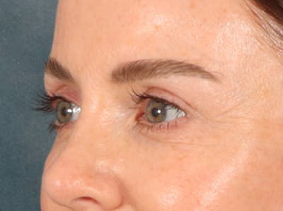 Eyelid Lift Before & After Gallery - Patient 173585 - Image 8