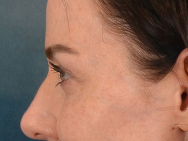 Eyelid Lift Before & After Gallery - Patient 173585 - Image 9