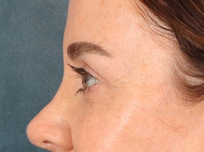 Eyelid Lift Before & After Gallery - Patient 173585 - Image 10
