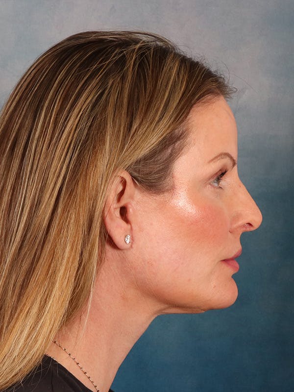 Deep Plane Facelift Before & After Gallery - Patient 148969 - Image 10