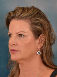 Deep Plane Facelift Before & After Gallery - Patient 148969 - Image 1