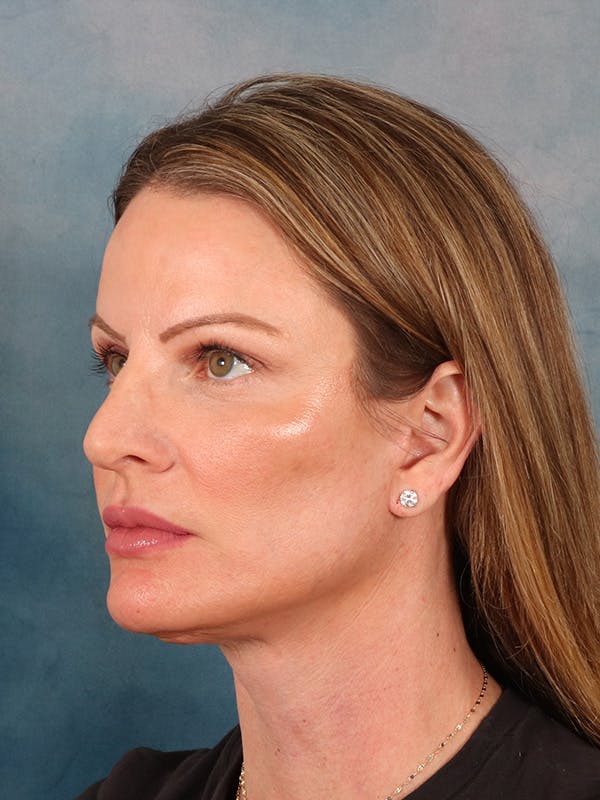 Deep Plane Facelift Before & After Gallery - Patient 148969 - Image 2