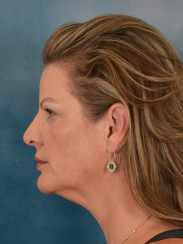 Deep Plane Facelift Before & After Gallery - Patient 148969 - Image 3