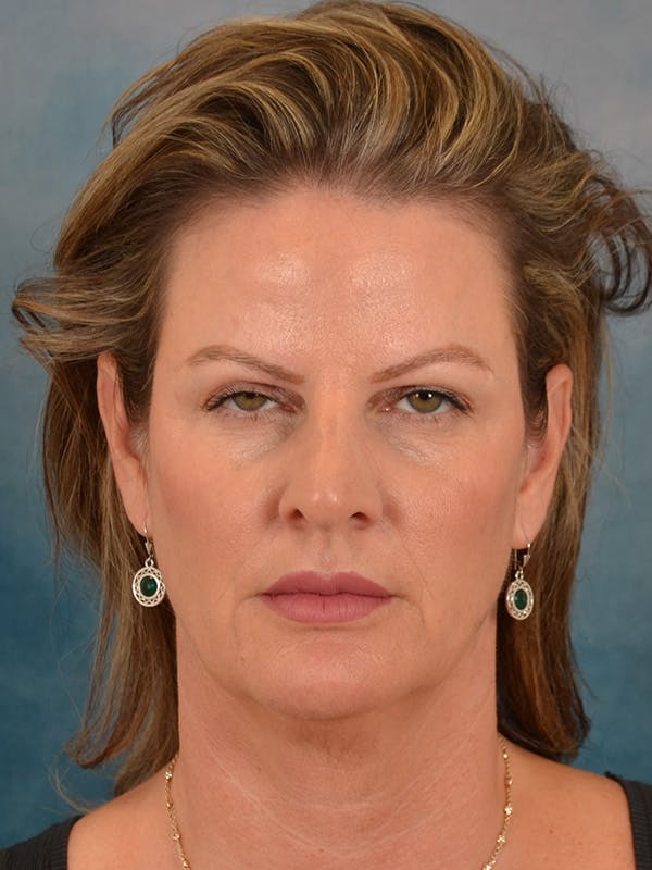 Deep Plane Facelift Before & After Gallery - Patient 148969 - Image 5