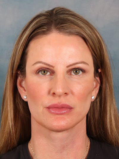 Deep Plane Facelift Before & After Gallery - Patient 148969 - Image 6