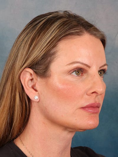 Deep Plane Facelift Before & After Gallery - Patient 148969 - Image 8
