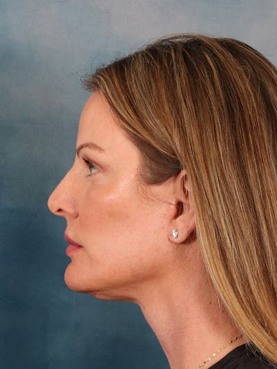 Deep Plane Facelift Before & After Gallery - Patient 148969 - Image 4