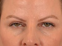 Eyelid Lift Before & After Gallery - Patient 550237 - Image 1
