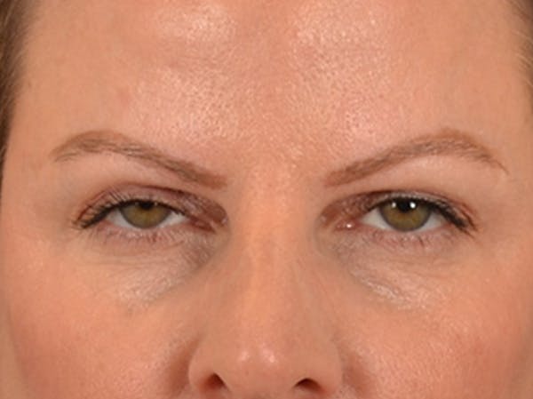 Eyelid Lift Before & After Gallery - Patient 550237 - Image 1