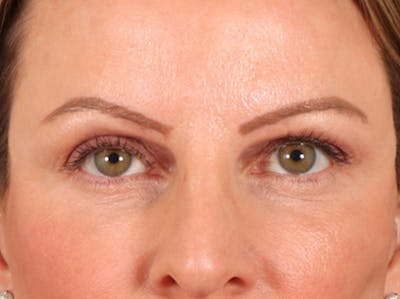 Eyelid Lift Before & After Gallery - Patient 550237 - Image 2