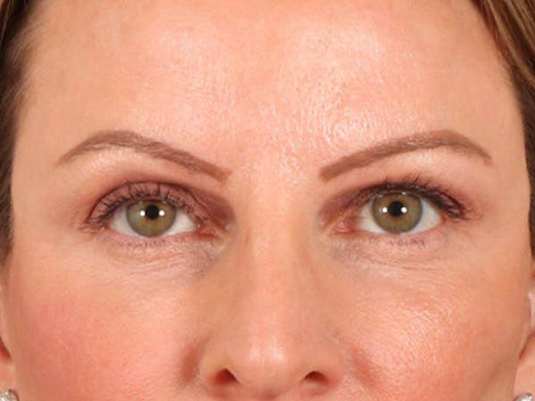 Eyelid Lift Before & After Gallery - Patient 550237 - Image 2