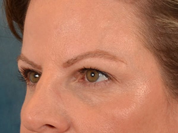 Eyelid Lift Before & After Gallery - Patient 550237 - Image 7
