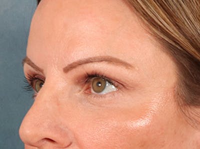 Eyelid Lift Before & After Gallery - Patient 550237 - Image 8