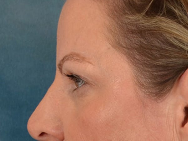 Eyelid Lift Before & After Gallery - Patient 550237 - Image 9