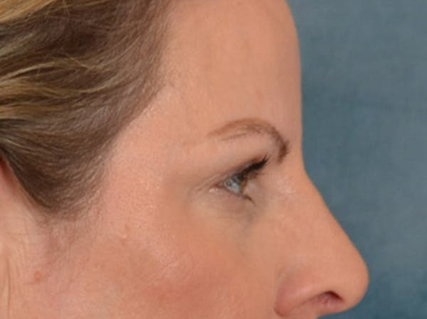 Eyelid Lift Before & After Gallery - Patient 550237 - Image 5