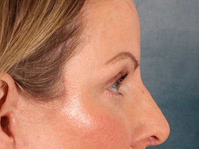 Eyelid Lift Before & After Gallery - Patient 550237 - Image 6