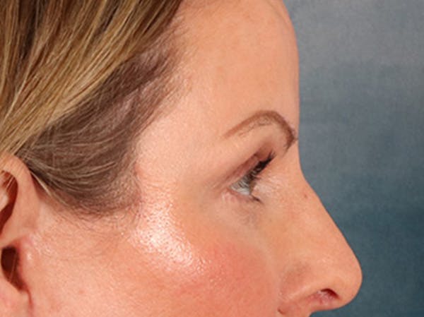 Eyelid Lift Before & After Gallery - Patient 550237 - Image 6