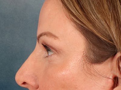 Eyelid Lift Before & After Gallery - Patient 550237 - Image 10