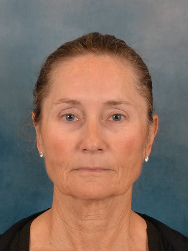 Deep Plane Facelift Before & After Gallery - Patient 631335 - Image 3