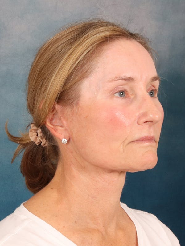 Deep Plane Facelift Before & After Gallery - Patient 631335 - Image 8