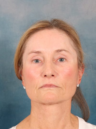 Deep Plane Facelift Before & After Gallery - Patient 631335 - Image 4