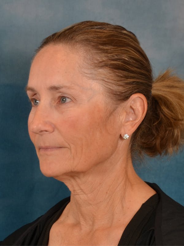 Deep Plane Facelift Before & After Gallery - Patient 631335 - Image 1