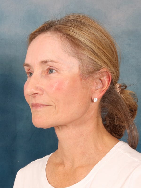 Deep Plane Facelift Before & After Gallery - Patient 631335 - Image 2