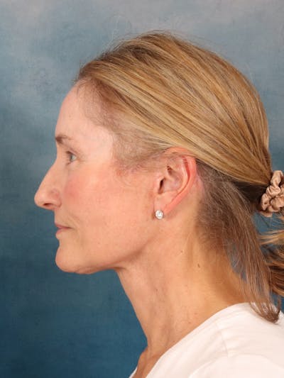 Deep Plane Facelift Before & After Gallery - Patient 631335 - Image 6