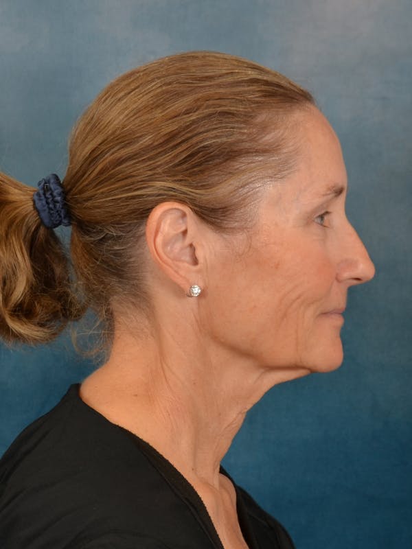 Deep Plane Facelift Before & After Gallery - Patient 631335 - Image 9
