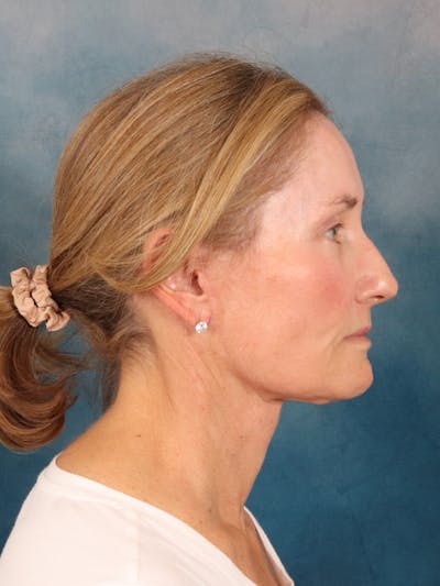 Deep Plane Facelift Before & After Gallery - Patient 631335 - Image 10