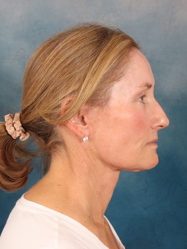 Deep Plane Facelift Before & After Gallery - Patient 631335 - Image 10