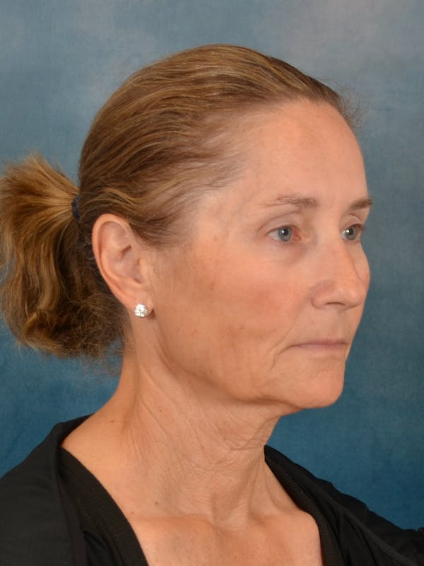 Deep Plane Facelift Before & After Gallery - Patient 631335 - Image 7