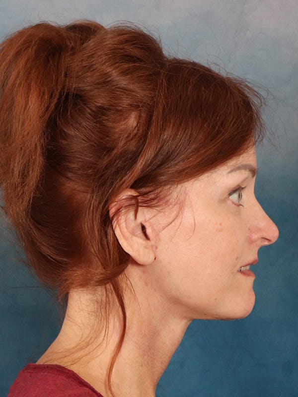 Laser Skin Resurfacing Before & After Gallery - Patient 405803 - Image 10